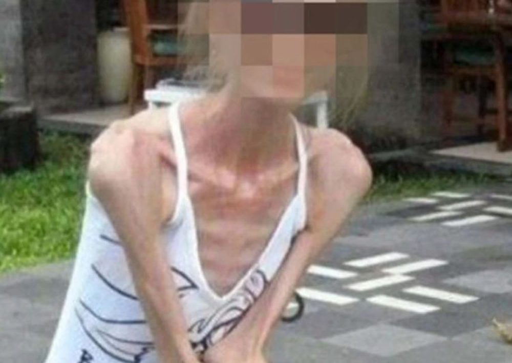 Người phụ nữ Trung Quốc mắc chứng biếng ăn tâm thần sau khi giảm 40kg trong 1 năm - ảnh 1