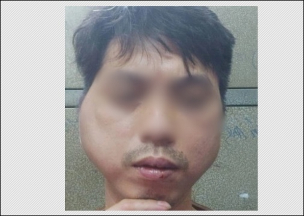 Vụ thanh niên 29 tuổi tố bị chủ quán lẩu nướng đánh biến dạng mặt: Thông tin mới nhất - ảnh 1