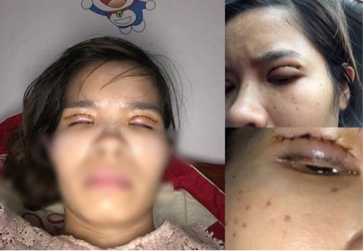 Một phụ nữ nguy cơ mù sau khi cắt mí mắt ở cơ sở thẩm mỹ 'chui' - ảnh 4