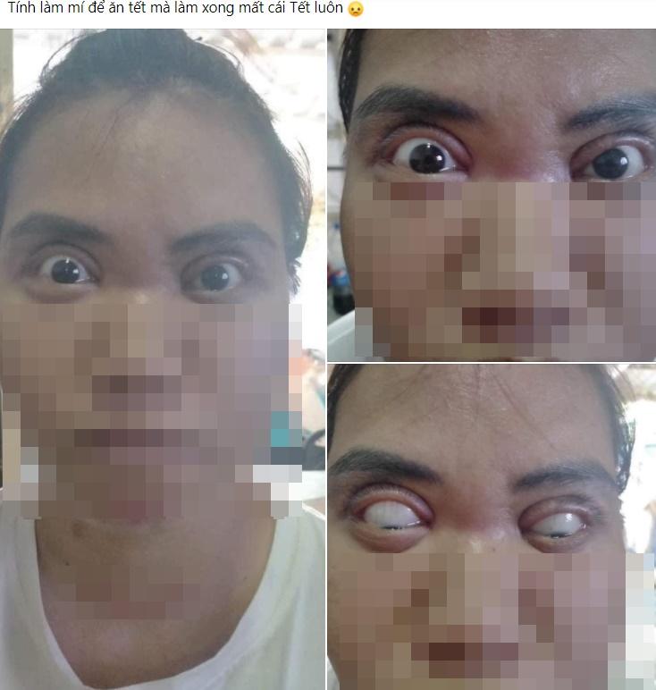 Một phụ nữ nguy cơ mù sau khi cắt mí mắt ở cơ sở thẩm mỹ 'chui' - ảnh 5
