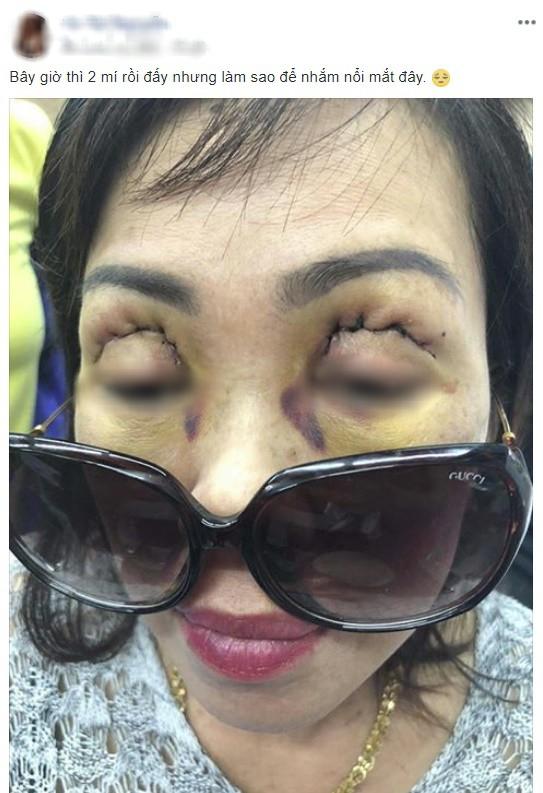 Một phụ nữ nguy cơ mù sau khi cắt mí mắt ở cơ sở thẩm mỹ 'chui' - ảnh 3