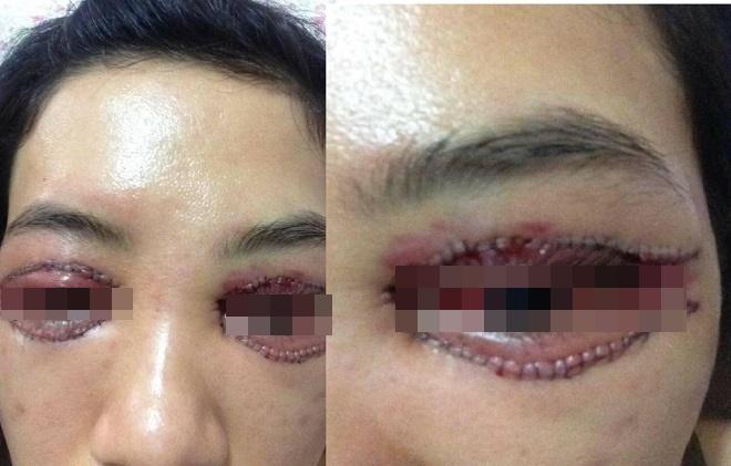 Một phụ nữ nguy cơ mù sau khi cắt mí mắt ở cơ sở thẩm mỹ 'chui' - ảnh 2