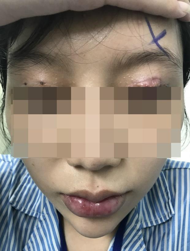 Một phụ nữ nguy cơ mù sau khi cắt mí mắt ở cơ sở thẩm mỹ 'chui' - ảnh 1