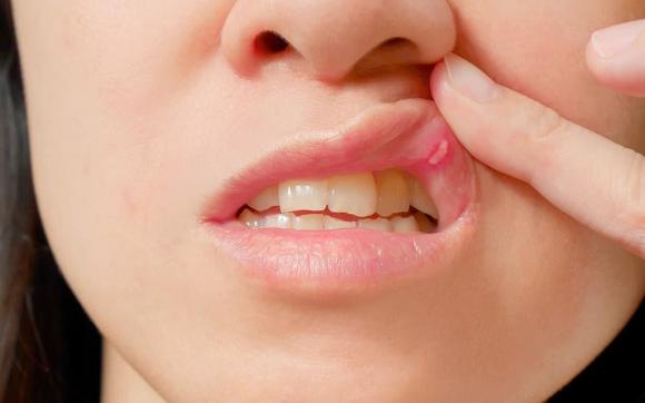 Nguyên nhân gì dẫn đến nhiệt miệng và 15 cách để giúp vết nhiệt miệng nhanh lành - ảnh 3