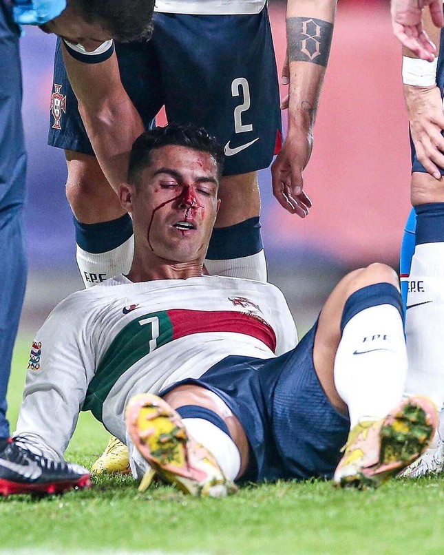 Ronaldo bê bết máu vì bị thủ môn đối phương đấm gãy mũi - ảnh 1
