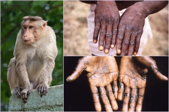 TP.HCM ghi nhận ca bệnh đậu mùa khỉ đầu tiên - ảnh 1