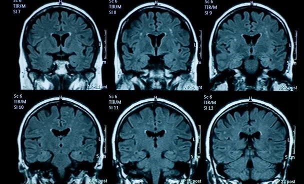 Dấu hiệu lão hóa sớm ở não bộ thanh thiếu niên sau đại dịch COVID-19 - ảnh 1