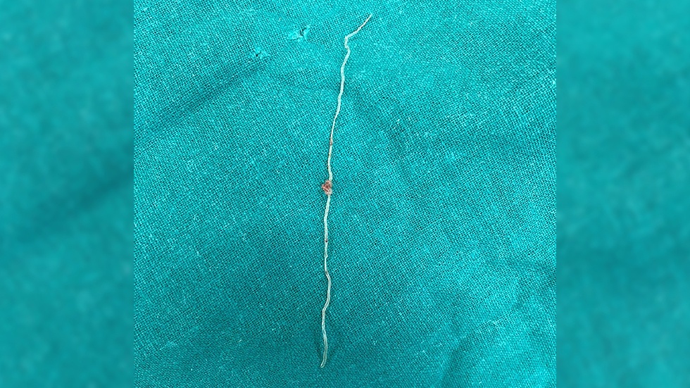 Giun dài 12 cm ký sinh trong má sau khi bị muỗi đốt - ảnh 1