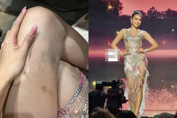 Ngọc Châu 'bầm dập' cơ thể sau Miss Universe 2022 - ảnh 3