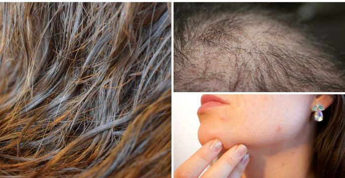 Chuyên gia cảnh báo thói quen làm tăng nguy cơ rụng tóc, khiến vi khuẩn phát triển - ảnh 2