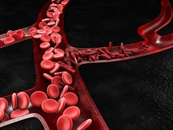 Khi máu đặc, cơ thể có 3 biểu hiện, hãy điều chỉnh kịp thời để tránh tắc nghẽn mạch máu - ảnh 1