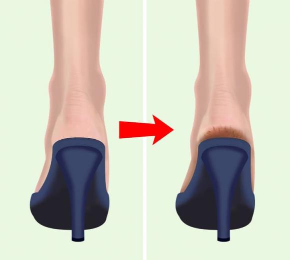 Tại sao gót chân bị nứt và cách khắc phục tự nhiên - ảnh 3