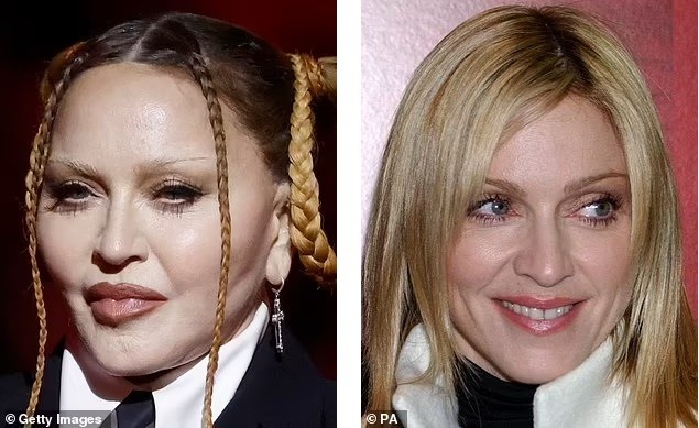 Bác sĩ thẩm mỹ nói về khuôn mặt không thể nhận ra của Madonna - ảnh 2