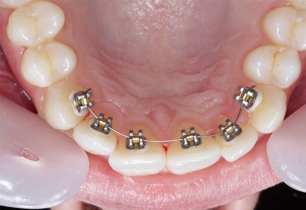 Ưu, nhược điểm của các phương pháp niềng răng trên thị trường: Nên lựa chọn hình thức chỉnh nha nào? - ảnh 3
