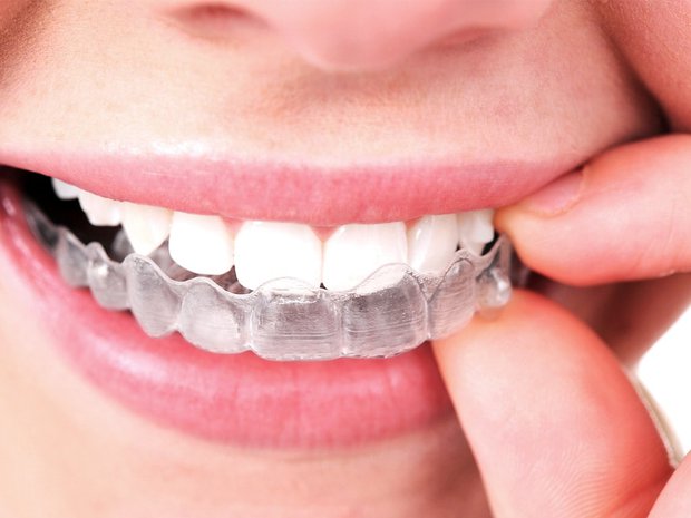 Ưu, nhược điểm của các phương pháp niềng răng trên thị trường: Nên lựa chọn hình thức chỉnh nha nào? - ảnh 5
