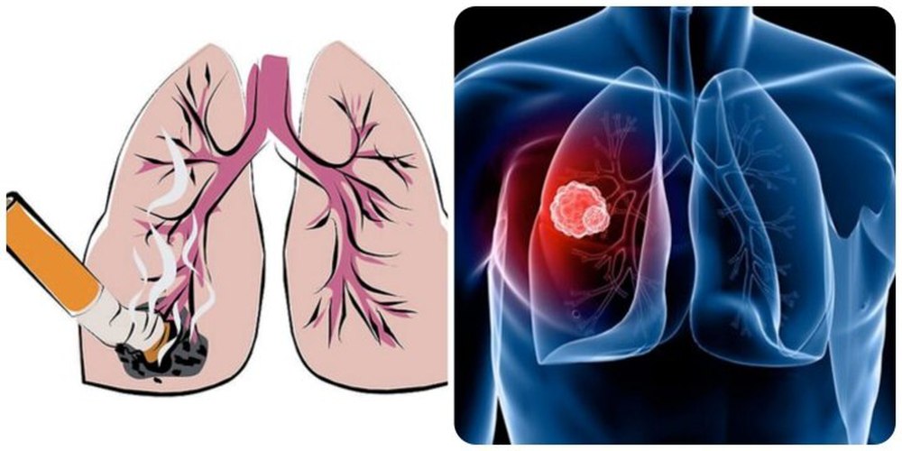 9 dấu hiệu ung thư phổi giai đoạn đầu - ảnh 1
