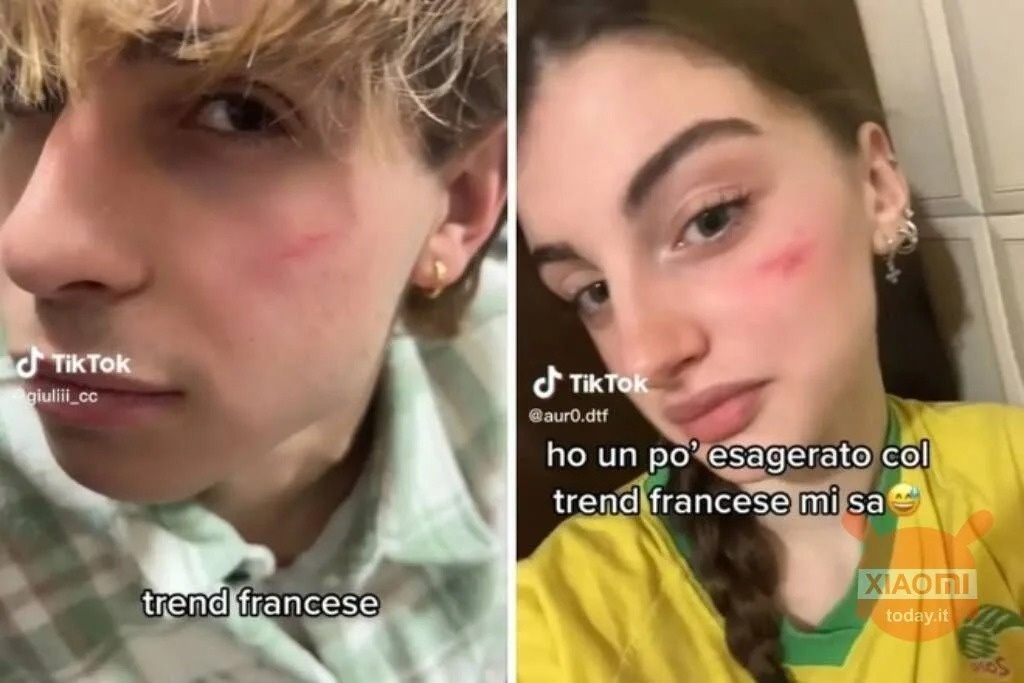 Thử thách độc hại ‘French scar’ khiến TikTok bị điều tra - ảnh 3