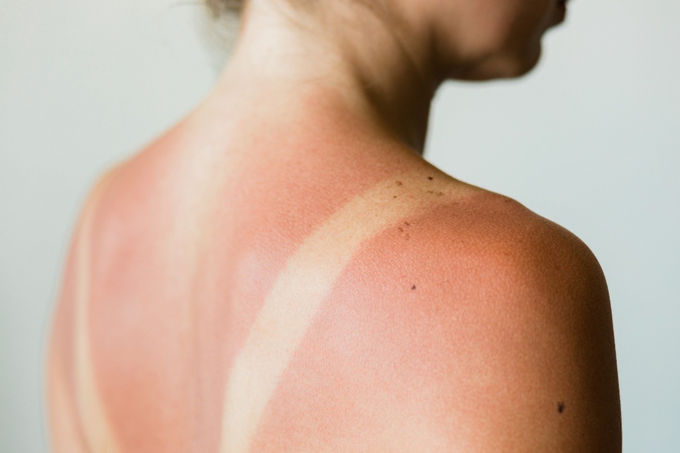 Cách xử lý da tại nhà khi bị cháy nắng - ảnh 1