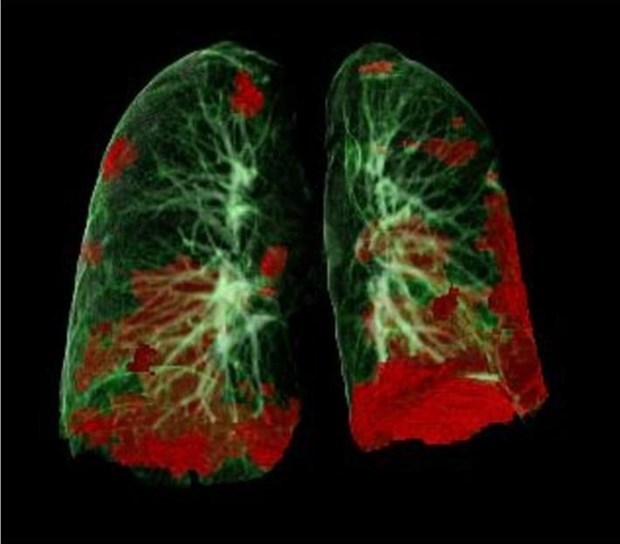Thử nghiệm thuốc mới chữa viêm phổi cho kết quả khả quan - ảnh 1