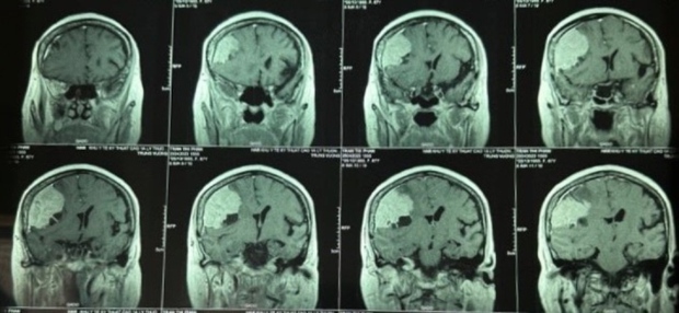 Đi khám đau đầu, phát hiện khối u màng não to hơn quả trứng - ảnh 1