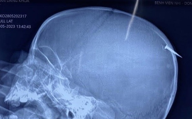 Phẫu thuật kịp thời cho bé trai bị cây đinh dài 3cm đâm qua xương sọ - ảnh 1