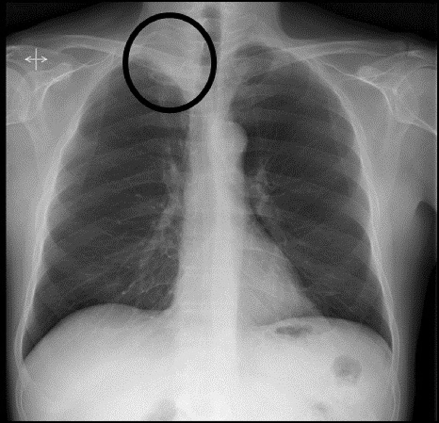 2 vị trí đau bất thường cảnh báo ung thư phổi nhưng dễ bị bỏ qua - ảnh 2