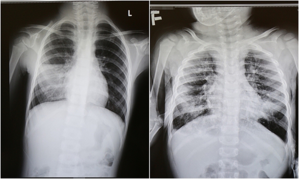 Quảng Ninh: Tăng đột biến số trẻ nhập viện vì viêm phổi - ảnh 1