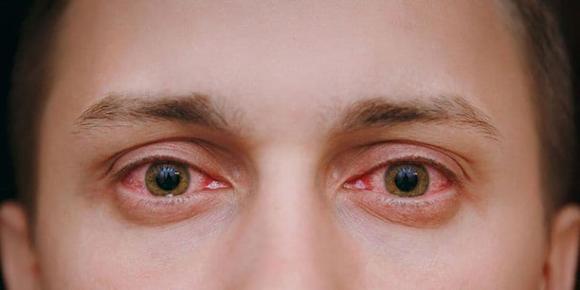 Đau mắt đỏ dễ lây, cách hạn chế nhiễm bệnh mà ai cũng nên biết trong thời điểm này - ảnh 2