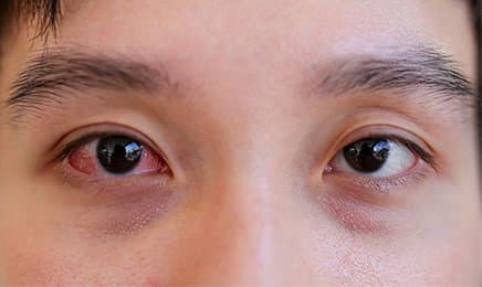 Đau mắt đỏ dễ lây, cách hạn chế nhiễm bệnh mà ai cũng nên biết trong thời điểm này - ảnh 1