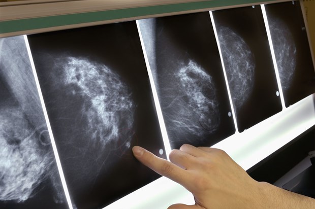 Thời điểm phụ nữ nên đi khám sàng lọc để sớm phát hiện ung thư vú - ảnh 3