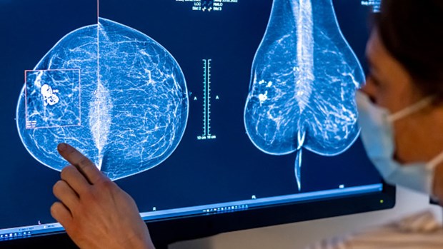 Thời điểm phụ nữ nên đi khám sàng lọc để sớm phát hiện ung thư vú - ảnh 2