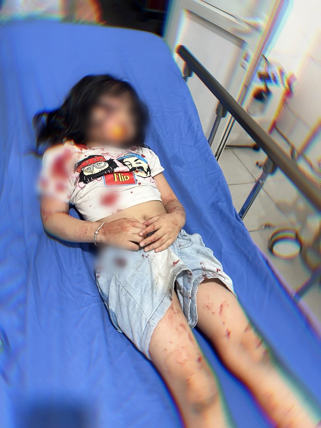 Bé 5 tuổi ở Hà Giang bị chó cắn trọng thương: Người mẹ bủn rủn khi thấy con bê bết máu - ảnh 1