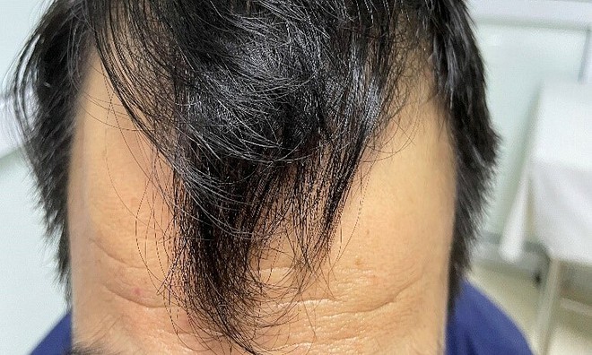 Nam thanh niên 31 tuổi nhập viện vì rụng tóc, tiêu chảy, phát hiện nguyên nhân do ăn thiếu 1 thứ mỗi ngày - ảnh 2
