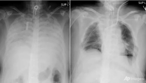 Chụp X-quang phát hiện nhiều người trẻ phổi trắng xóa, nguyên nhân vì đâu? - ảnh 2