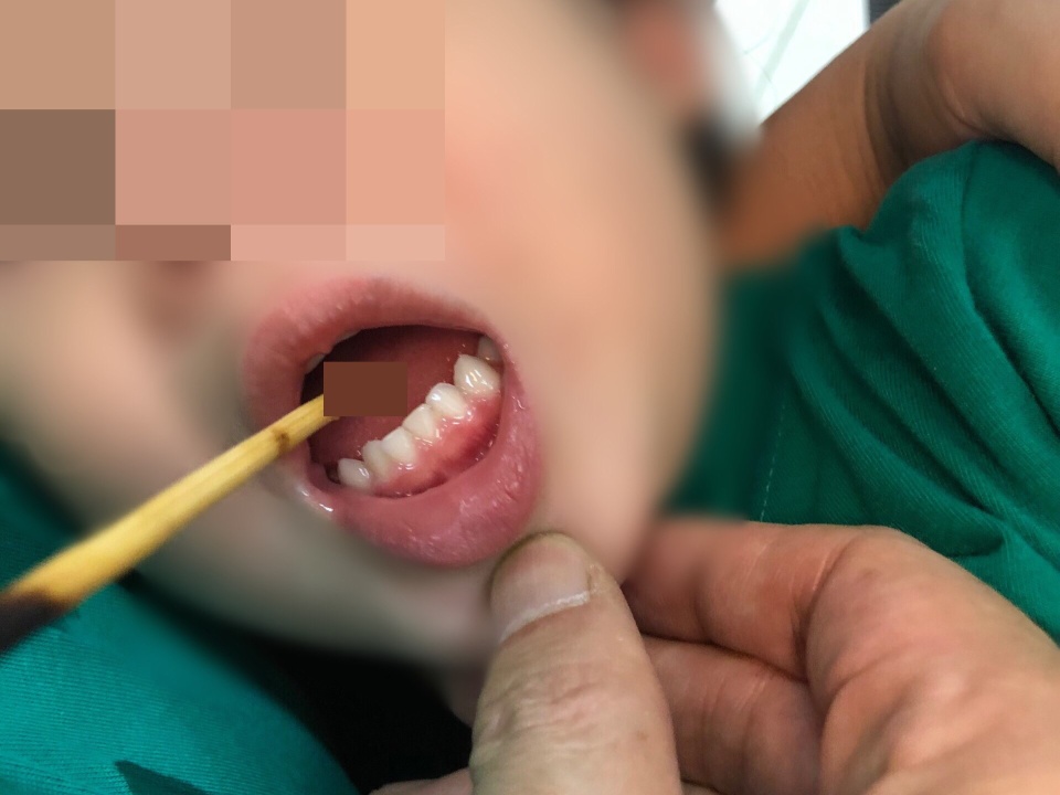 Tai nạn khiến bé 3 tuổi thủng lưỡi - ảnh 1