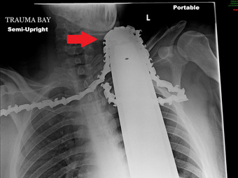 Thanh niên sống sót kỳ diệu sau khi bị máy cưa cứa cổ: Ảnh X-quang khiến ai cũng rùng mình