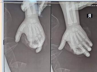 Máy xay sinh tố nghiền nát ngón tay bé gái ở Hà Nội