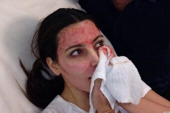 4 phương pháp làm đẹp đau đớn của Kim Kardashian: "Mặt nạ ma cà rồng" gây khiếp sợ