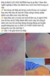 Nữ sinh lớp 7 ở Nghệ An tố bị thầy giáo đánh bầm tím tay