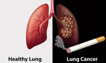 Nếu có 4 dấu hiệu bất thường ở đầu, hãy cảnh giác sự xuất hiện của ung thư phổi