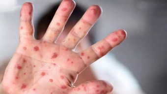 CDC Mỹ lạc quan về hiệu quả của vắc-xin đậu mùa khỉ