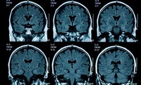 Dấu hiệu lão hóa sớm ở não bộ thanh thiếu niên sau đại dịch COVID-19