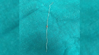 Giun dài 12 cm ký sinh trong má sau khi bị muỗi đốt