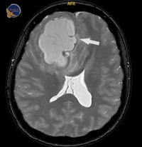 Khối u 5 cm trốn trong não nữ bệnh nhân Campuchia