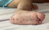 Virus Enterovirus 71 gây bệnh tay chân miệng nặng xuất hiện trở lại​