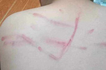 Không làm bài tập, học sinh lớp 4 ở Thanh Hóa bị cô giáo đánh lằn lưng
