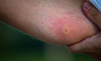 Muỗi đốt gây ra những bệnh truyền nhiễm nào?
