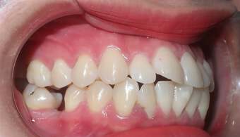 Bác sĩ bật mí: Đây chính xác là những điều niềng răng sẽ làm thay đổi trên khuôn mặt bạn!