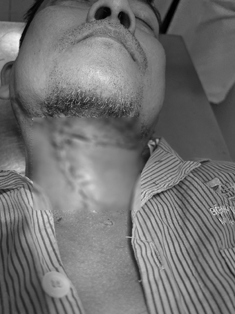 Người đàn ông ở TP.HCM đau răng 10 ngày không khỏi, bác sĩ mở vùng dưới hàm phát hiện cả ổ mủ "bốc mùi"