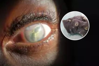 Người phụ nữ bị nhiễm ký sinh trùng ở mắt vì ăn thịt cá sấu